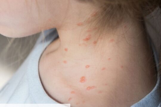 chickenpox:-here-are-the-3-regions-that-exceed-the-epidemic-threshold