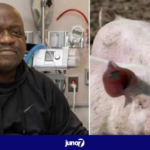 united-states:-death-of-the-first-patient-who-received-a-pig-kidney