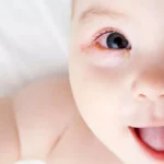 baby-conjunctivitis:-how-to-recognize-and-treat-it?