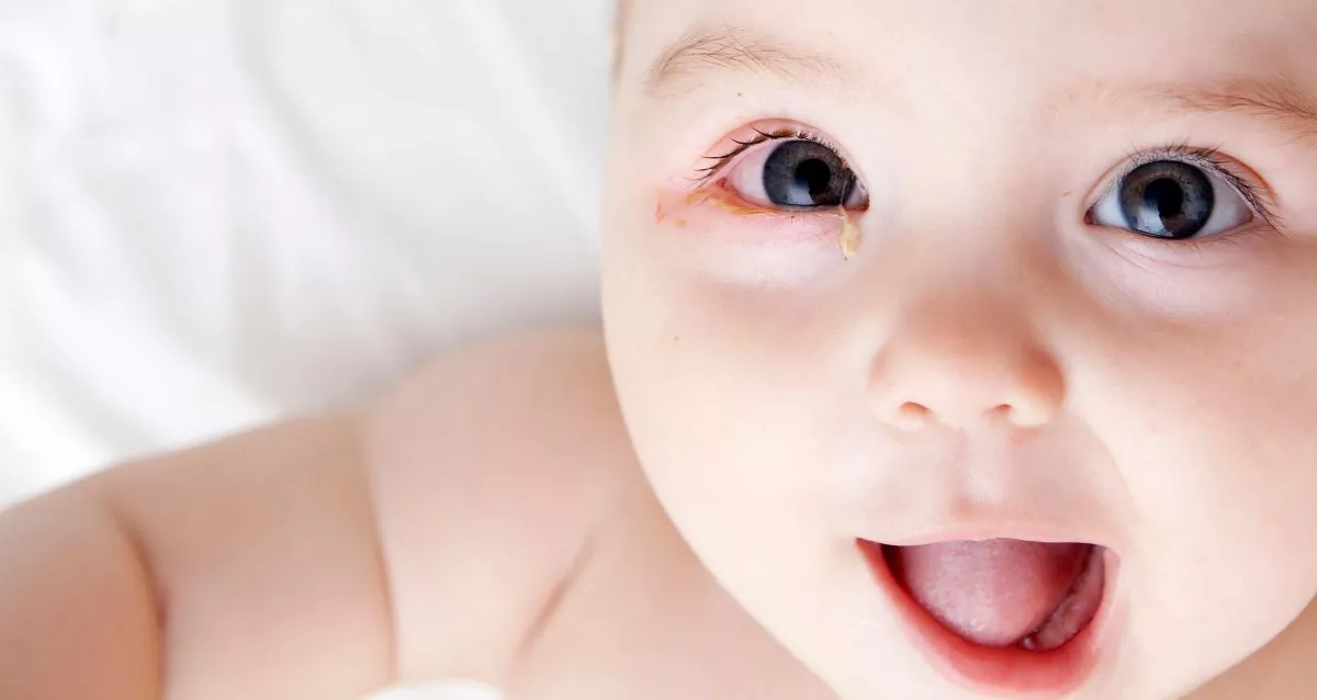 baby-conjunctivitis:-how-to-recognize-and-treat-it?
