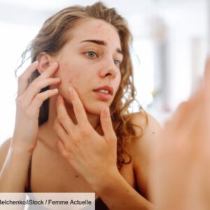 these-eating-habits-may-help-reduce-acne,-study-finds
